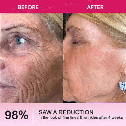 👨‍⚕️Made and shipped from USA 💫Rolimey® Botox & Retinol Shot Wrinkle Reducing Multi Balm - Last Day Promotion 70% OFF